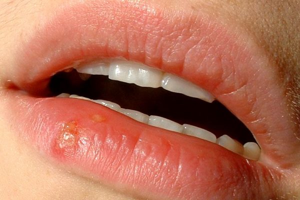 How to get rid of cold sores fast?