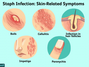 staph infection on skin