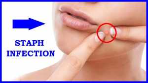 staph infections on skin