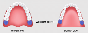 wisdom tooth extraction cost