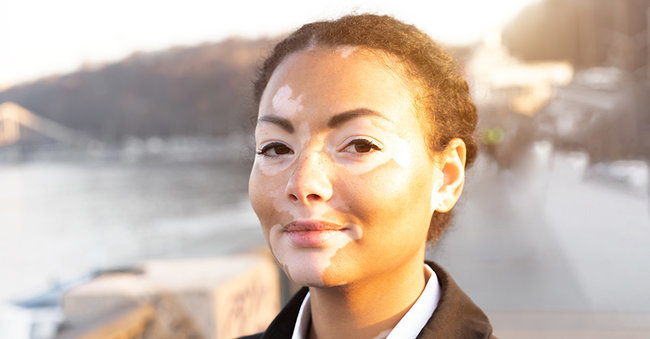 vitiligo