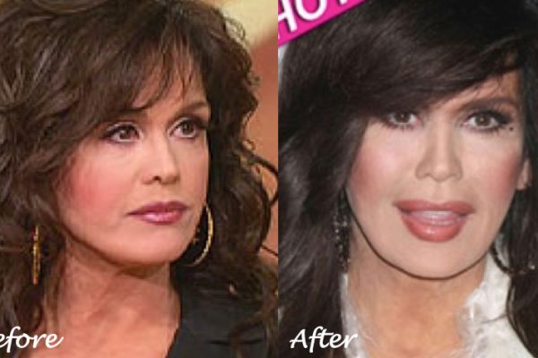 Marie Osmond Plastic Surgery