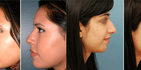 How Much Do Nose Job Cost